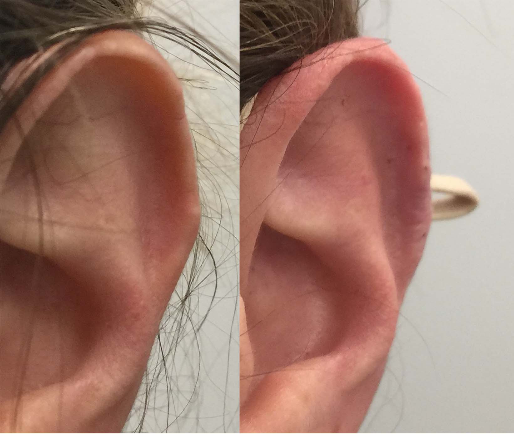 Ear Lobe Cosmetic Repair Clinic